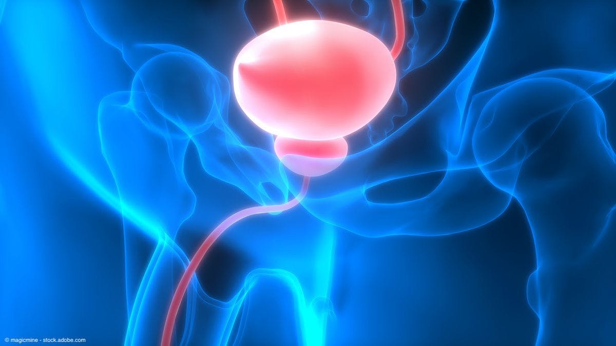 Study highlights efficacy of prostate artery embolization in BPH