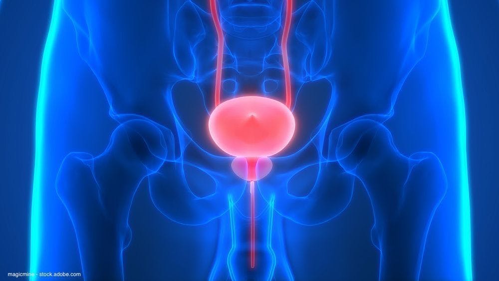 Baseline BPH symptoms important to treatment selection for some patients with prostate cancer