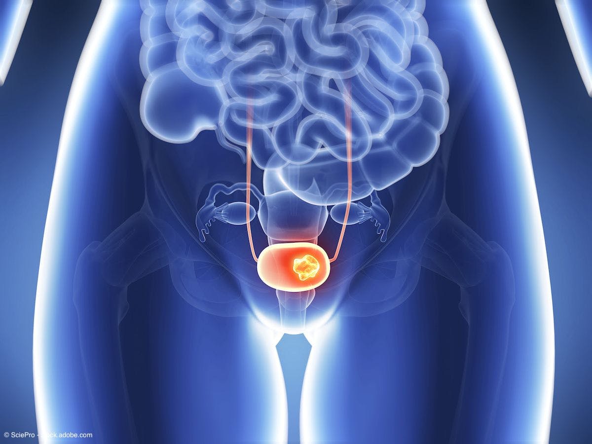 Visugromab shows initial efficacy and safety in urothelial carcinoma