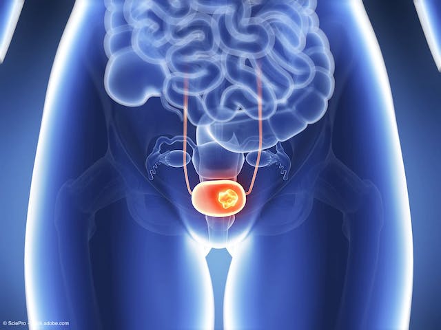 medical depiction of bladder cancer on xray