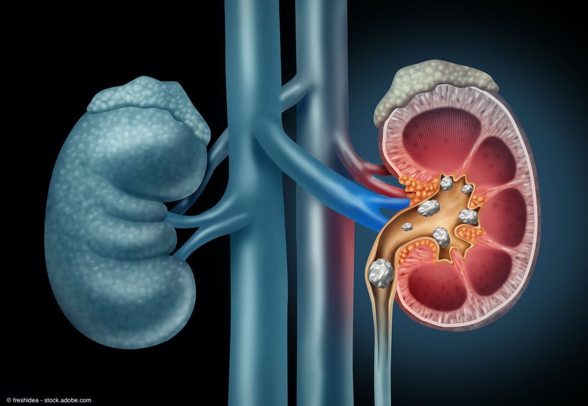 cross section of human kidneys, one of which contains stones